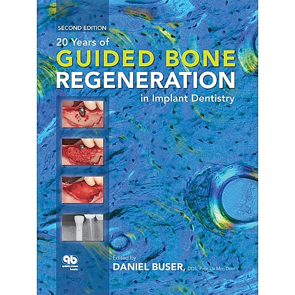 20 Years of Guided Bone Regeneration in Implant Dentistry, Daniel Buser