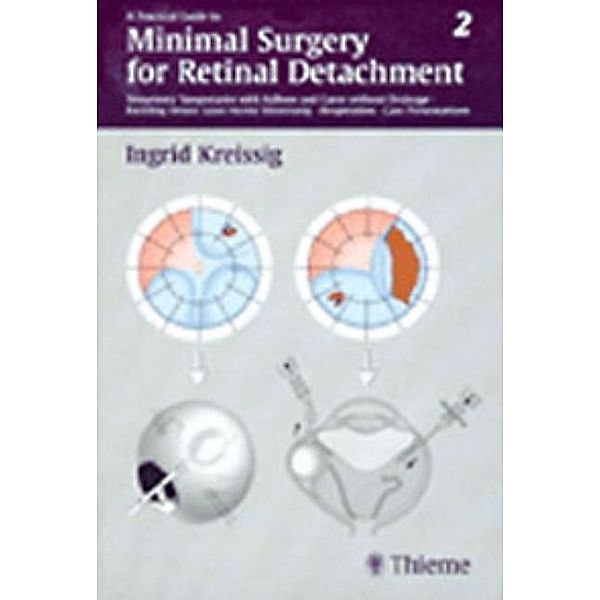 A Practical Guide to Minimal Surgery for Retinal Detachment: Vol.2 Temporary Tamponades with Balloon andf Cases without Drainage, Buckling versus Cases versus Vitrectomy, Reoperation, Cas, Ingrid Kreissig
