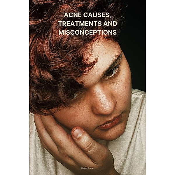 Acne causes,  treatments and misconceptions, Unem Othman
