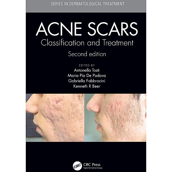 Acne Scars