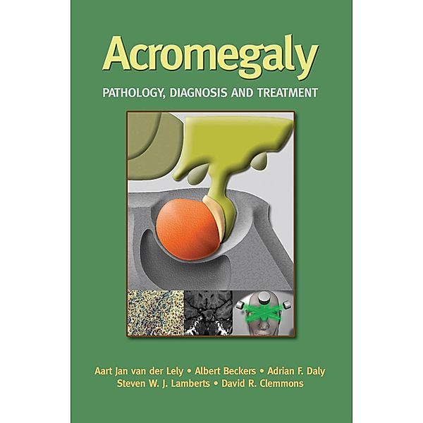 Acromegaly, Aart Jan van der Lely, Albert Beckers, Adrian Daly, Steven W. Lamberts, David R. Clemmons