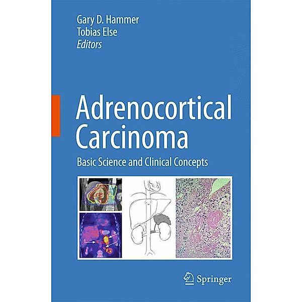 Adrenocortical Carcinoma