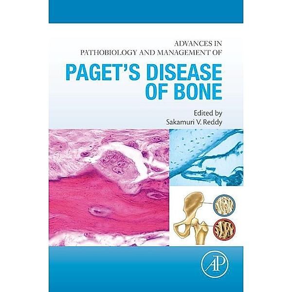 Advances in Pathobiology and Management of Paget's Disease of Bone