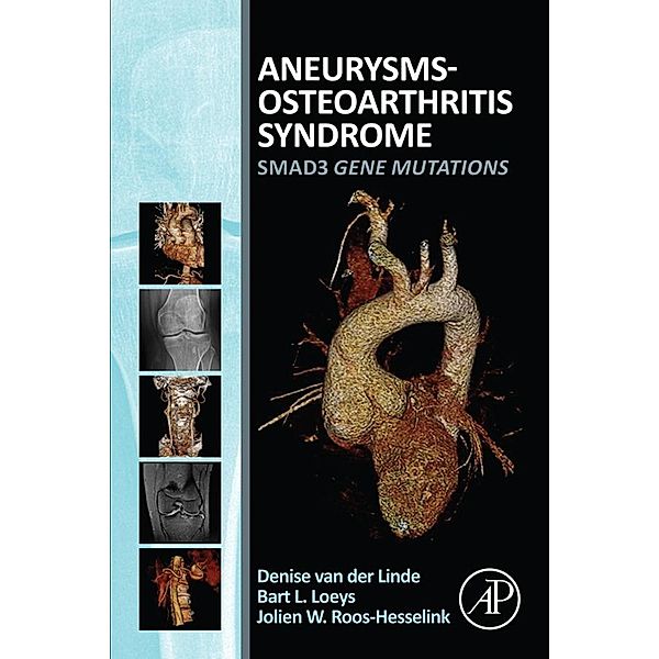 Aneurysms-Osteoarthritis Syndrome, Denise van der Linde, Jolien Roos-Hesselink, Bart L. Loeys