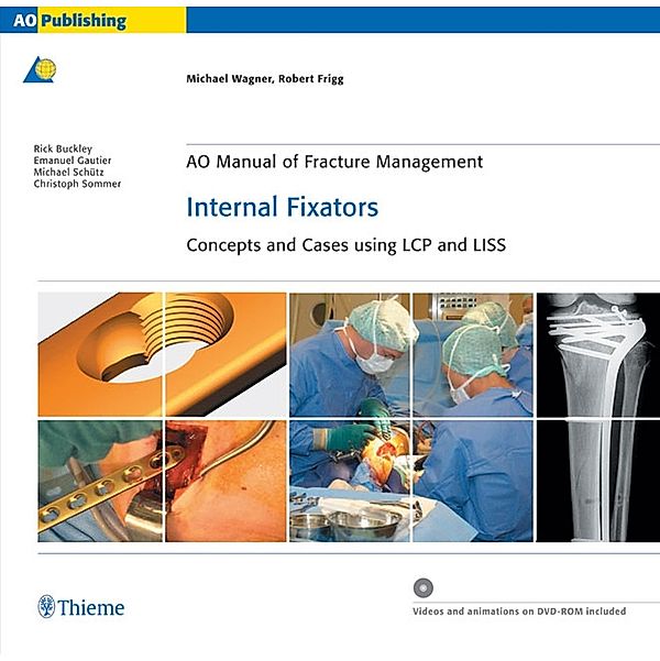 AO Manual of Fracture Management: Internal Fixators, Michael Wagner, Robert Frigg