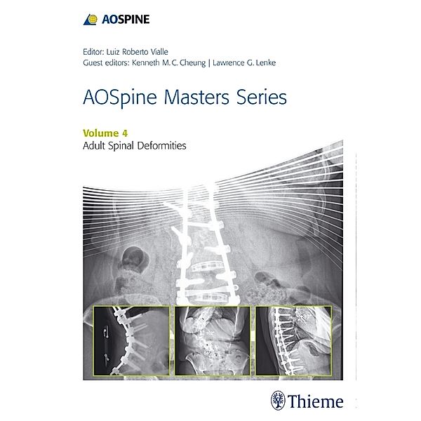 AOSpine Master Series - Adult Spinal Deformities