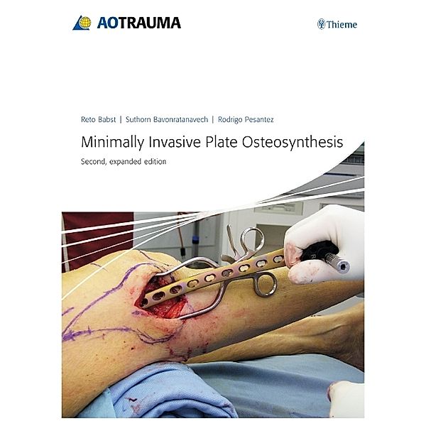 AOTrauma / Minimally Invasive Plate Osteosynthesis, Reto Babst, Suthorn Bavonratanavech, Rodrigo F. Pesantez