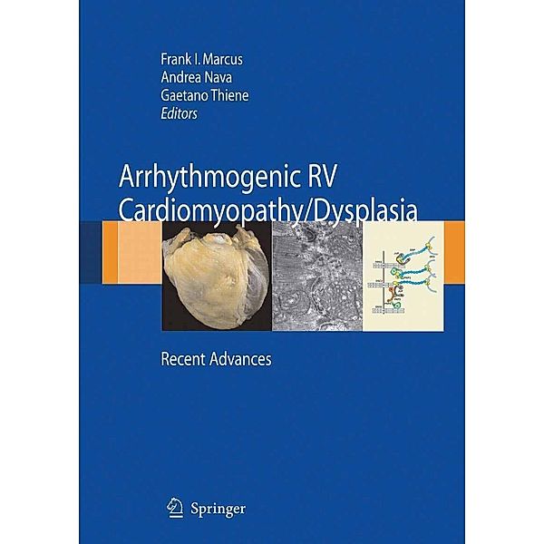 Arrhythmogenic RV Cardiomyopathy/Dysplasia