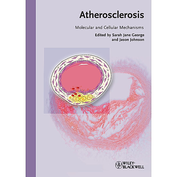 Atherosclerosis