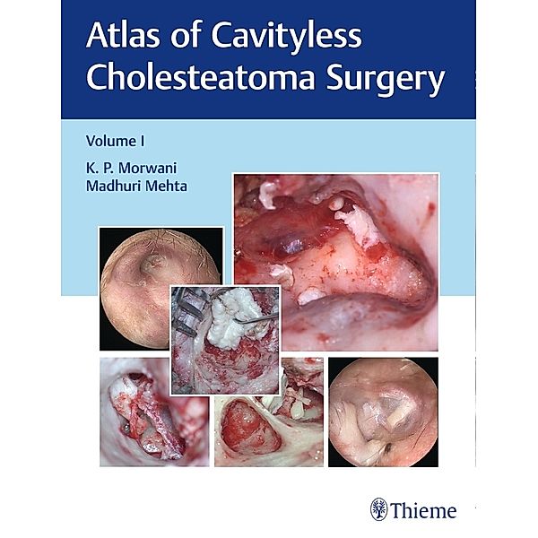 Atlas of Cavityless Cholesteatoma Surgery, Vol 1, K Morwani, Madhuri Mehta