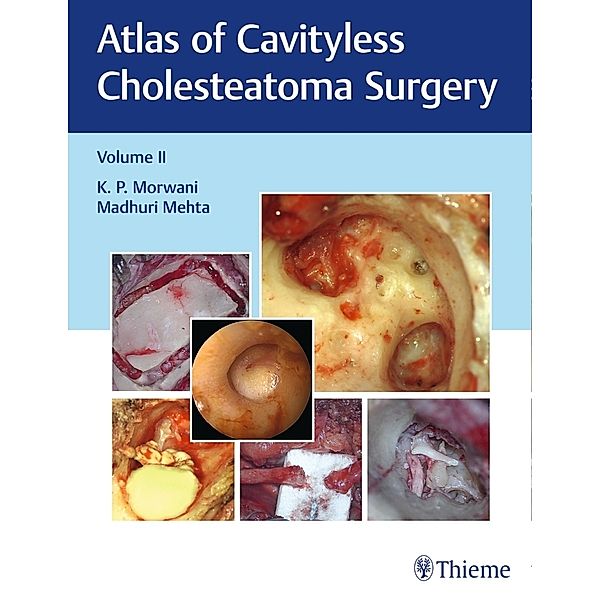 Atlas of Cavityless Cholesteatoma Surgery, Vol 2.Vol.2, K Morwani, Madhuri Mehta