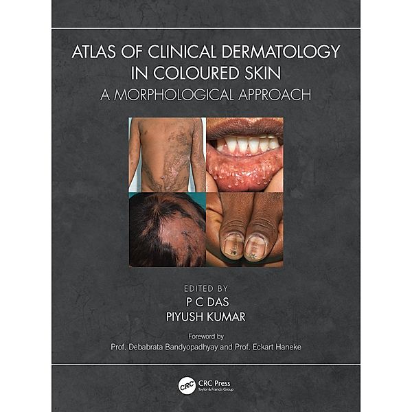 Atlas of Clinical Dermatology in Coloured Skin