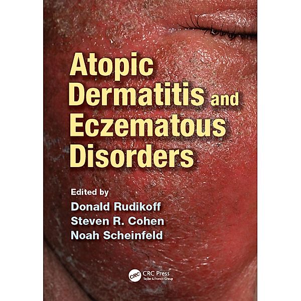 Atopic Dermatitis and Eczematous Disorders