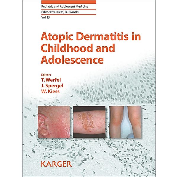 Atopic Dermatitis in Childhood and Adolescence