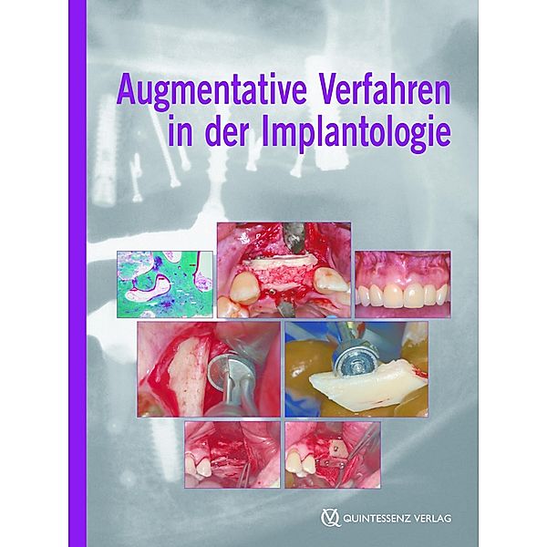 Augmentative Verfahren in der Implantologie, Fouad Khoury