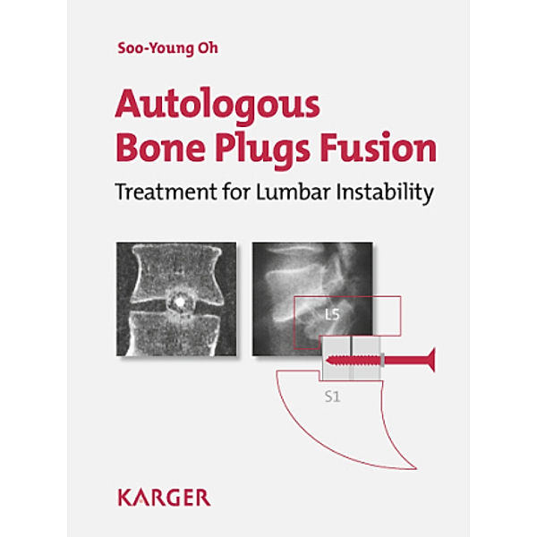 Autologous Bone Plugs Fusion, S.-Y. Oh