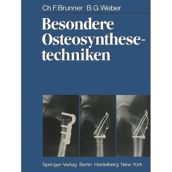 Besondere Osteosynthesetechniken, C. F. Brunner, B. G. Weber