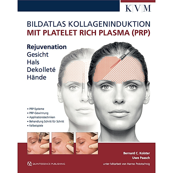 Bildatlas Kollageninduktion mit Platelet Rich Plasma (PRP), Bernard C. Kolster, Uwe Paasch