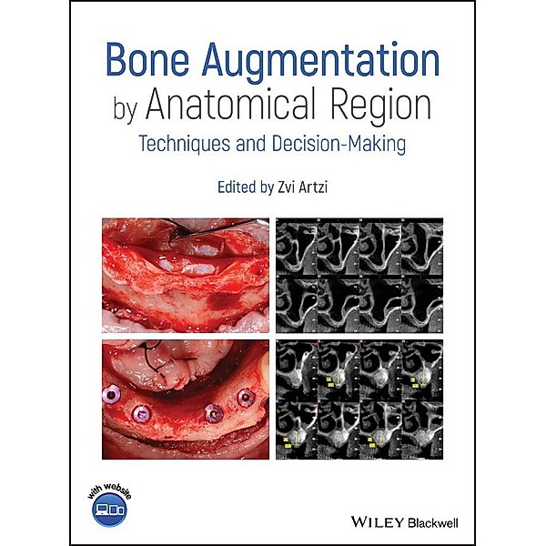 Bone Augmentation by Anatomical Region