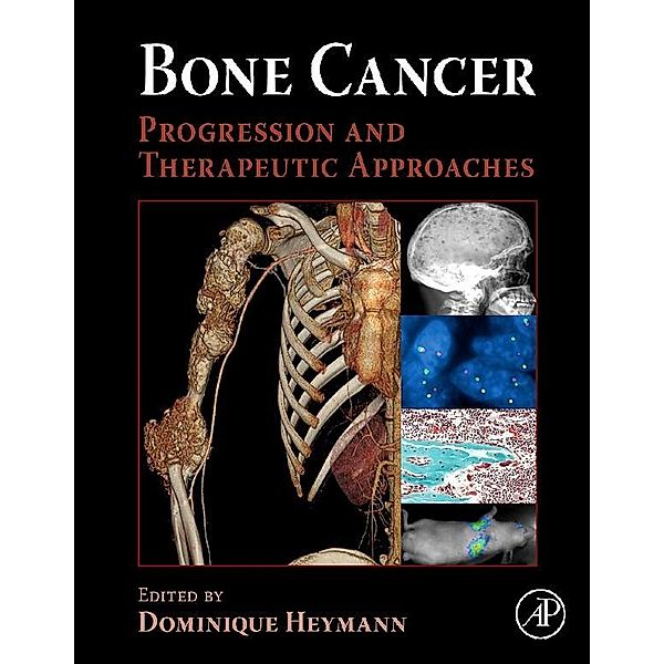 Bone Cancer