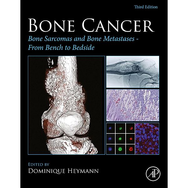 Bone Cancer