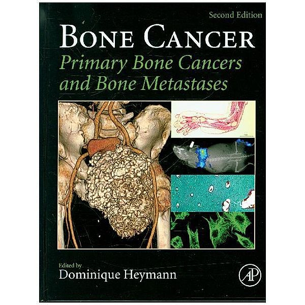 Bone Cancer