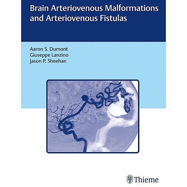 Brain Arteriovenous Malformations and Arteriovenous Fistulas