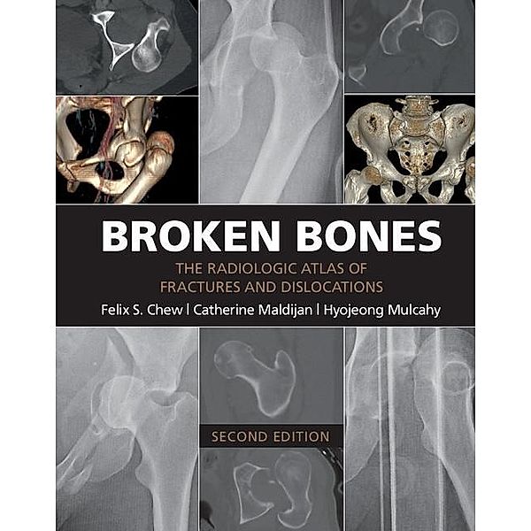 Broken Bones, Felix S. Chew