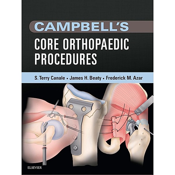Campbell's Core Orthopaedic Procedures E-Book, S. Terry Canale, James H. Beaty, Frederick M Azar