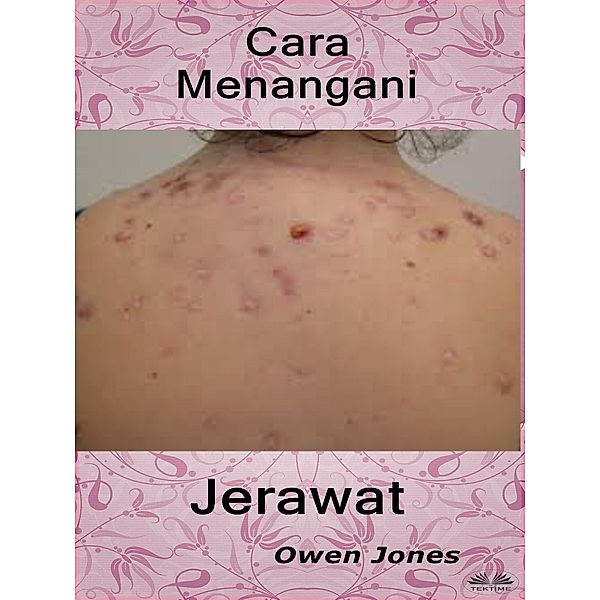 Cara Menangani Jerawat, Owen Jones