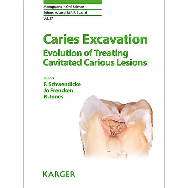 Caries Excavation: Evolution of Treating Cavitated Carious Lesions