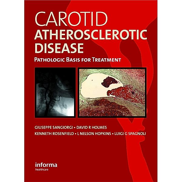 Carotid Atherosclerotic Disease