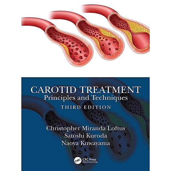 Carotid Treatment: Principles and Techniques, Christopher Miranda Loftus, Satoshi Kuroda, Naoya Kuwayama