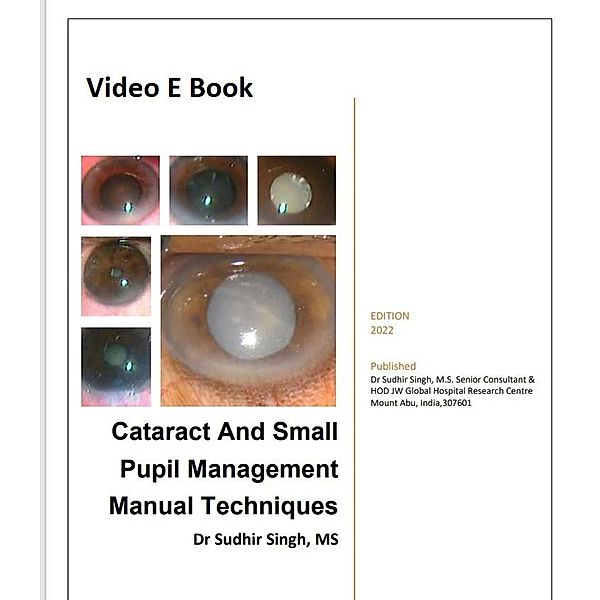 Cataract And Small Pupil Management Manual Techniques (2022, #1) / 2022, Sudhir Singh