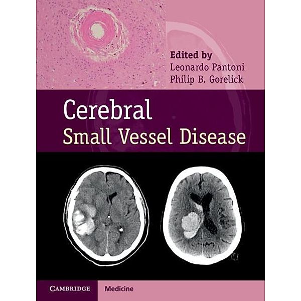 Cerebral Small Vessel Disease