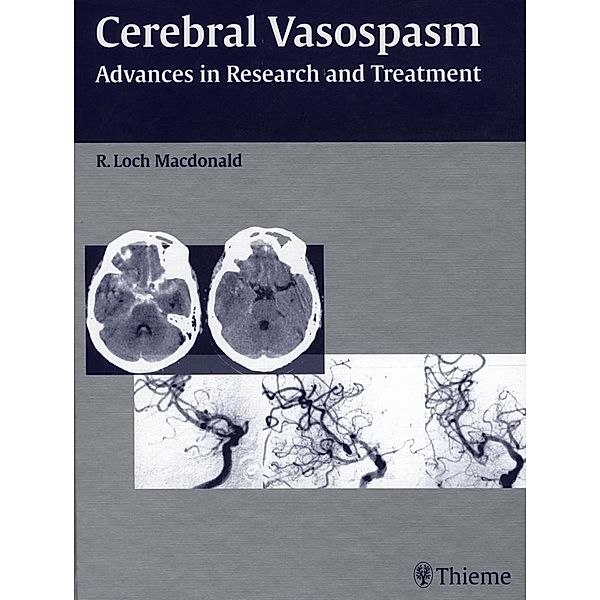 Cerebral Vasospasm, R. Loch Macdonald