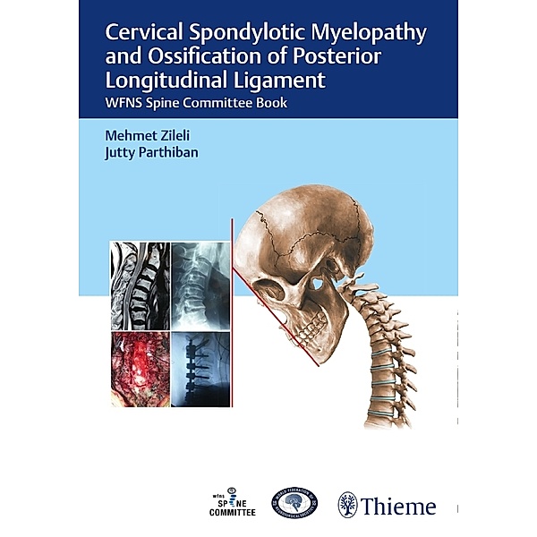 Cervical Spondylotic Myelopathy and Ossification of Posterior Longitudinal Ligament, Mehmet Zileli, J.K.B.C. Parthiban