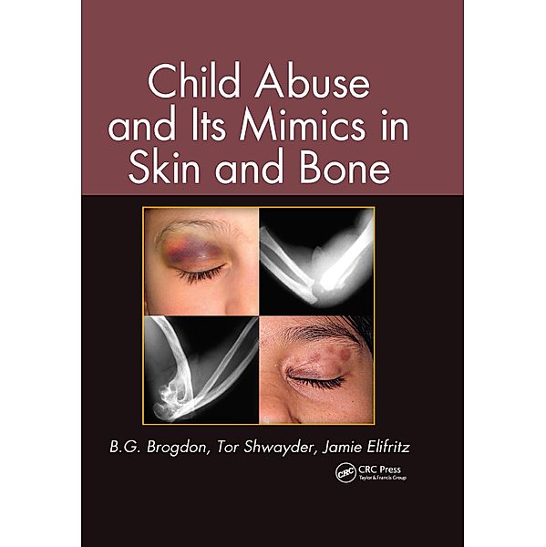 Child Abuse and its Mimics in Skin and Bone, B. G. Brogdon, Tor Shwayder, Jamie Elifritz