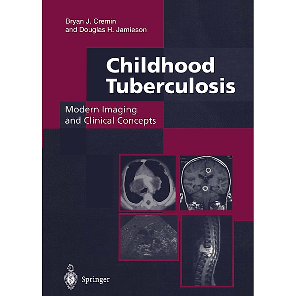 Childhood Tuberculosis: Modern Imaging and Clinical Concepts, Bryan J. Cremin, Douglas H. Jamieson