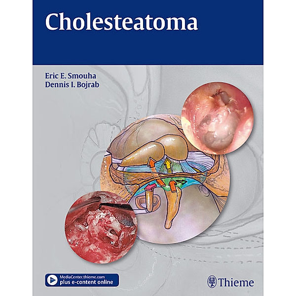 Cholesteatoma, Eric E. Smouha, Dennis I. Bojrab