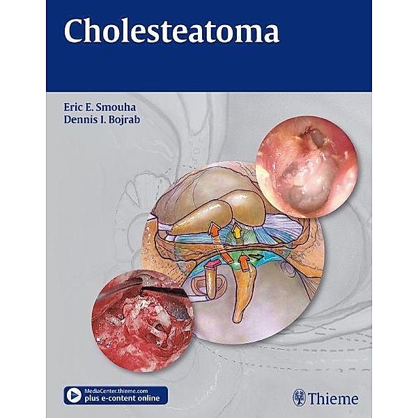 Cholesteatoma, Eric E. Smouha, Dennis I. Bojrab