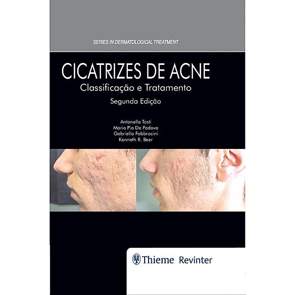 Cicatrizes de Acne, Antonella Tosti, Kenneth R. Beer, Maria Pia De Padova, Gabriella Fabbrocini