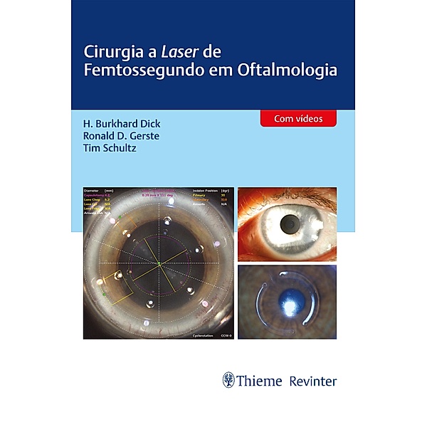 Cirurgia a Laser de Femtossegundo em Oftalmologia, H. Burkhard Dick, Ronald D. Gerste, Tim Schultz