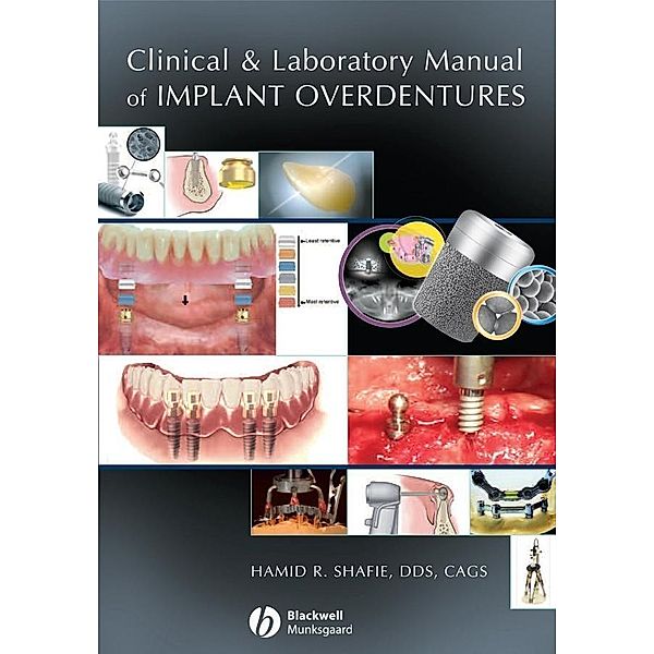 Clinical and Laboratory Manual of Implant Overdentures, Hamid R. Shafie