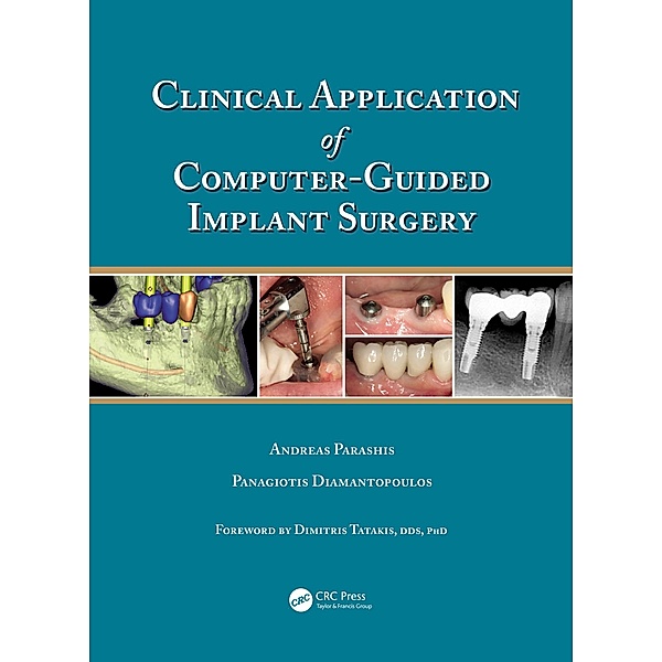Clinical Application of Computer-Guided Implant Surgery, Andreas Parashis, Panagiotis Diamantopoulos