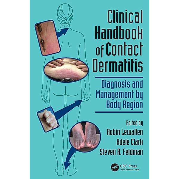 Clinical Handbook of Contact Dermatitis