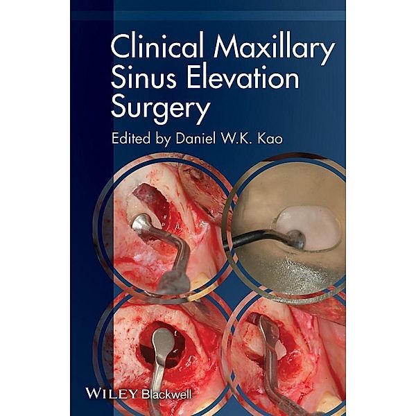 Clinical Maxillary Sinus Elevation Surgery