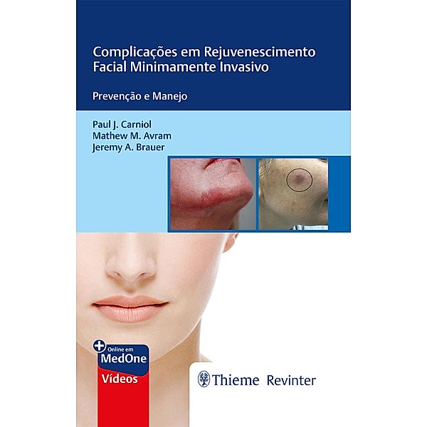 Complicações em Rejuvenescimento Facial Minimamente Invasivo, Paul J. Carniol, Mathew M. Avram, Jeremy A. Brauer