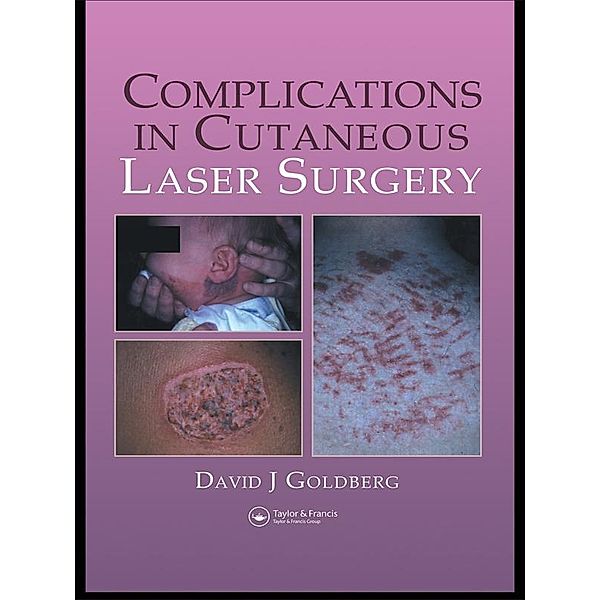 Complications in Laser Cutaneous Surgery, David J. Goldberg