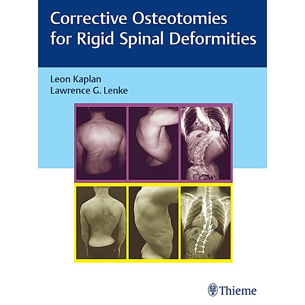 Corrective Osteotomies for Rigid Spinal Deformities